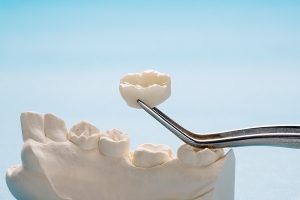 Read more about the article Does a Dental Crown Protect Your Tooth?